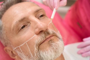 Hemşire smas kaldırmadan önce insan yüzünde işaretler yapıyor. Cerrahi olmayan yüz kaldırma. Yenilenme süreci. Spa tedavisi. Donanım kozmetolojisi