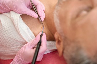 Dermatolog cerrah, radyonife 'li bir adamın boynundaki ben ya da nevusu çıkarır.