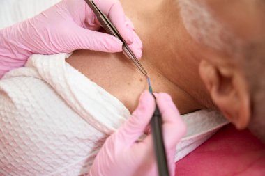 Cildiyecilerin kadın elleri modern bir tıp kliniğinde neoplazmaları radyo dalgası neşteriyle temizler. Kırpılmış