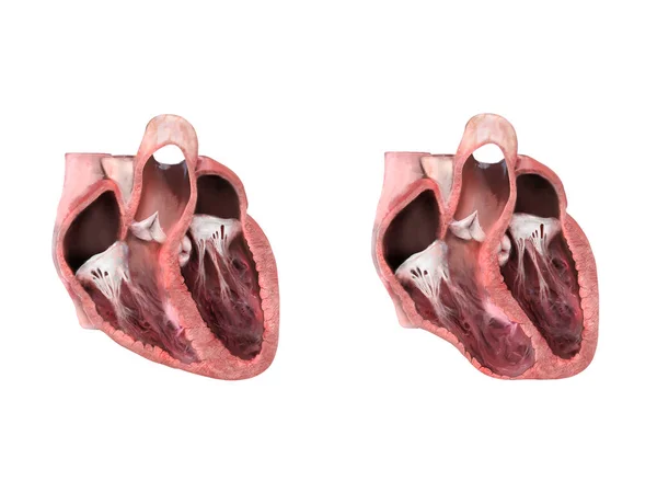 Zdrowe Serce Kontra Tętniak Anatomia Serca Tętniak Lewej Komory Wybrzuszenie — Zdjęcie stockowe