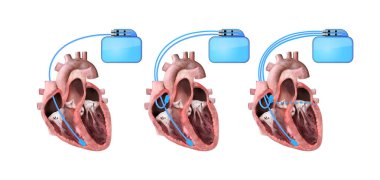 kalp ve kalp pili beyaz arka planda 3D görüntüleme, illüstrasyon kalp anatomisi, bölüm, sağ ve sol ventrikül, atria, valfler