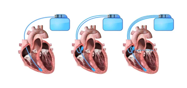 Hjärta Och Hjärta Pacemaker Vit Bakgrund Render Illustration Hjärta Anatomi — Stockfoto