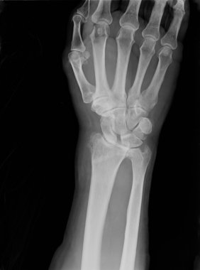 Xray kalıcı sentetik anlamı ile azaltılmış epiphysial Radyal kırık