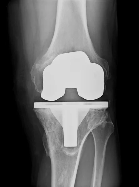 Protesi del ginocchio bicompartimentale a raggi X — Foto Stock