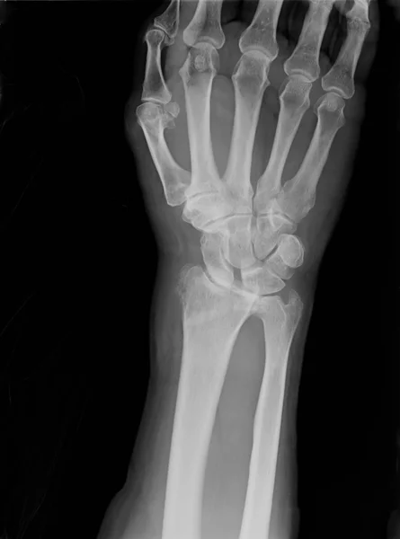 Xray of epiphysial radial fracture reduced with permanent synthetic means — Stock Photo, Image