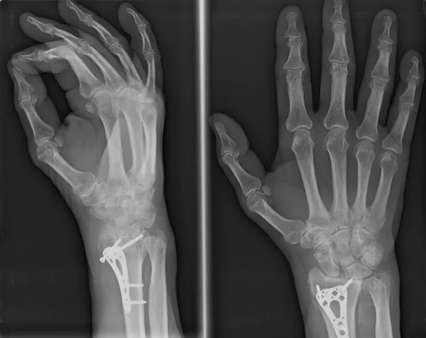 Рентгенівський знімок радіального перелому епіфізарії зменшується з постійними синтетичними засобами — стокове фото