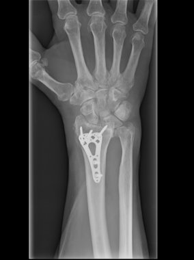 Xray kalıcı sentetik anlamı ile azaltılmış epiphysial Radyal kırık