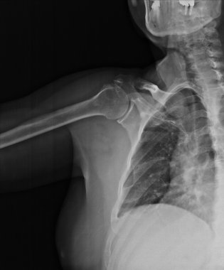 Xray