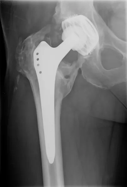 Permanent total hip arthroplasty xray — Stock Photo, Image