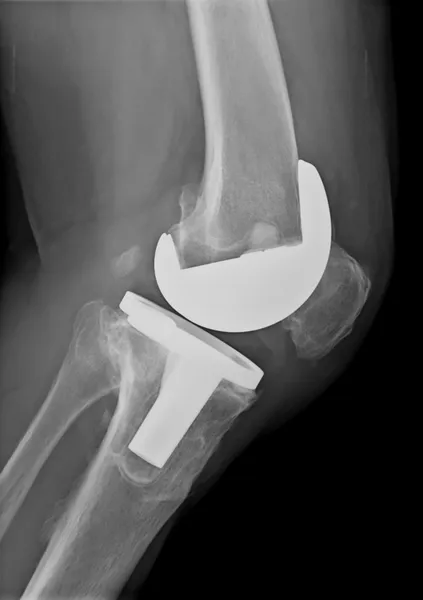 Bicompartmental knie prothese xray — Stockfoto