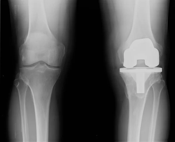 Protesi del ginocchio bicompartimentale a raggi X — Foto Stock