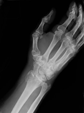 Xray kalıcı sentetik anlamı ile azaltılmış epiphysial Radyal kırık