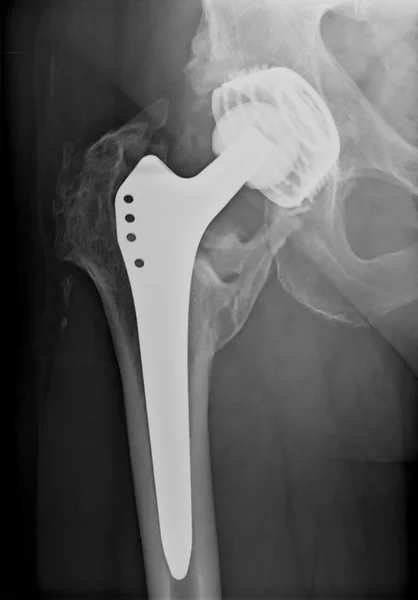 Permanent total hip arthroplasty xray — Stock Photo, Image