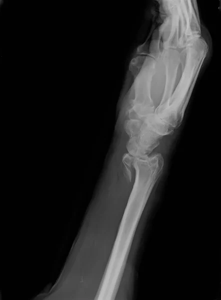 Рентгенівський знімок радіального перелому епіфізарії зменшується з постійними синтетичними засобами — стокове фото