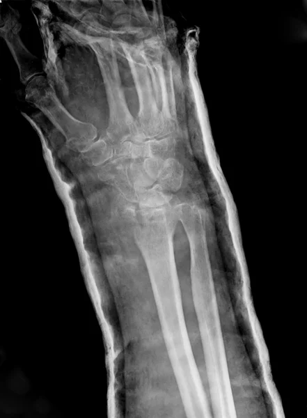 Xray of epiphysial radial fracture reduced with permanent synthetic means — Stock Photo, Image