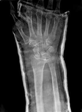 Xray kalıcı sentetik anlamı ile azaltılmış epiphysial Radyal kırık