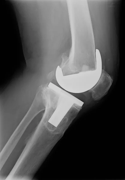 Bicompartmental kolenní protéza xray — Stock fotografie