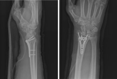 Xray kalıcı sentetik anlamı ile azaltılmış epiphysial Radyal kırık