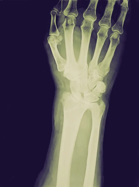 Retro look Xray of epiphysial radial fracture reduced with perma — Stock Photo, Image