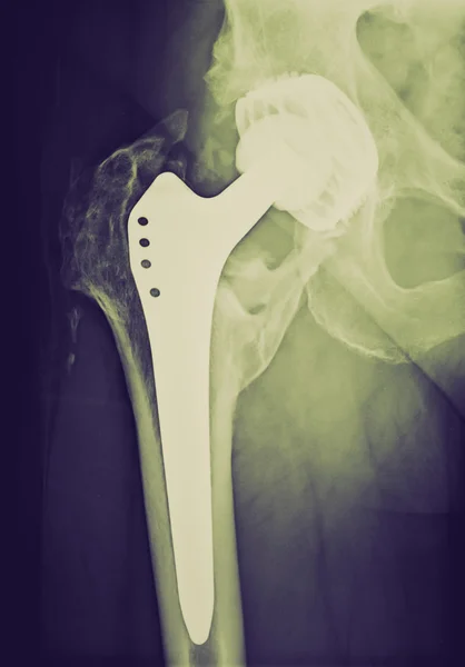 Retro look Permanent total hip arthroplasty xray — Stock Photo, Image