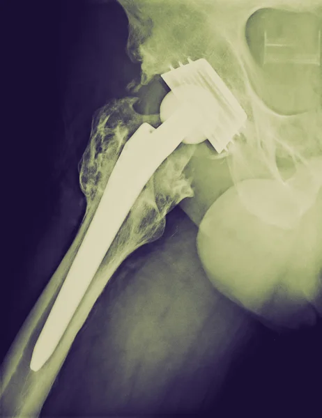 Retro look Permanent total hip arthroplasty xray — Stock Photo, Image