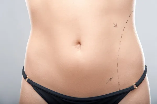 Woman belly marked out for cosmetic surgery — Stock Photo, Image
