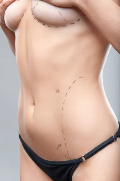 Woman belly marked out for cosmetic surgery — Stock Photo, Image