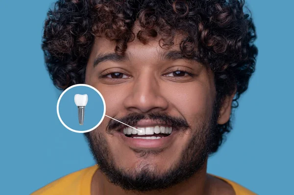 Young man with a toothy smile demonstrating his dental implant — Zdjęcie stockowe