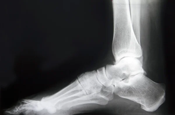 X-ray foot — Stock Photo, Image