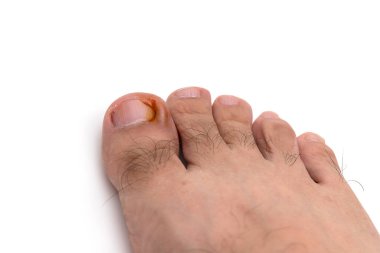 Nail figure is purulence onychocryptosis of toe isolated on white background