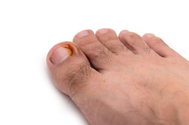 Tırnak şekli, beyaz arka planda izole edilmiş ayak parmağının kızarıklığı.