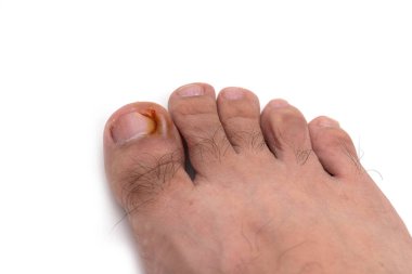 Tırnak şekli, beyaz arka planda izole edilmiş ayak parmağının kızarıklığı.