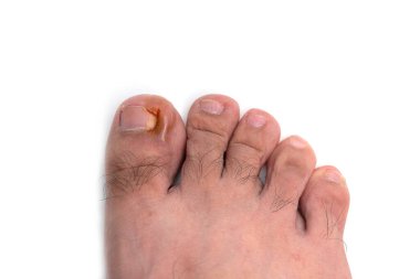 Nail figure is purulence onychocryptosis of toe isolated on white background