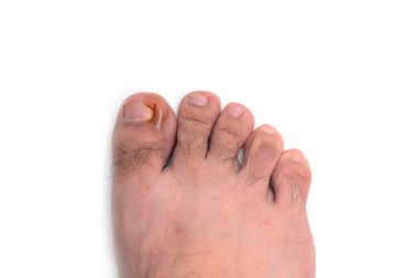 Tırnak şekli, beyaz arka planda izole edilmiş ayak parmağının kızarıklığı.