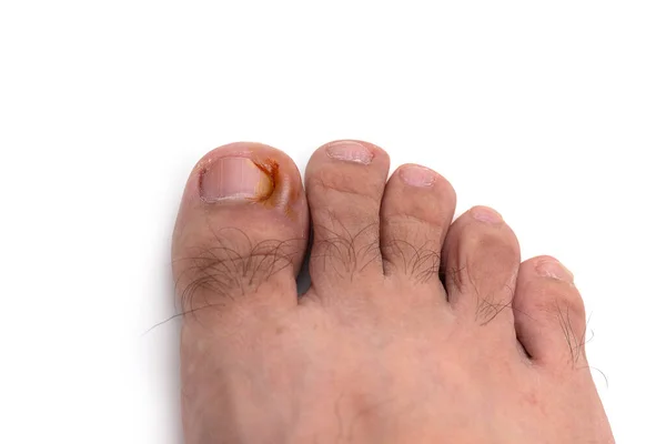 Nail Figure Purulence Onychocryptosis Toe Isolated White Background — Stockfoto