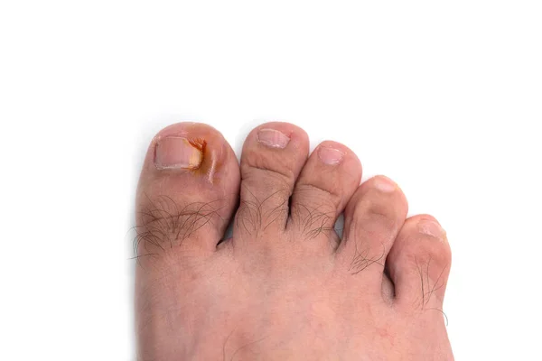 Nail Figure Purulence Onychocryptosis Toe Isolated White Background — Stockfoto