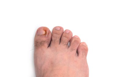 Tırnak şekli, beyaz arka planda izole edilmiş ayak parmağının kızarıklığı.