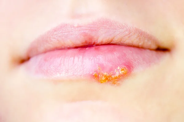 Herpes virüsü kadın ağzında — Stok fotoğraf