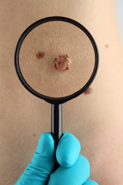 Birthmark. Dermatologist examines mole close up clipart