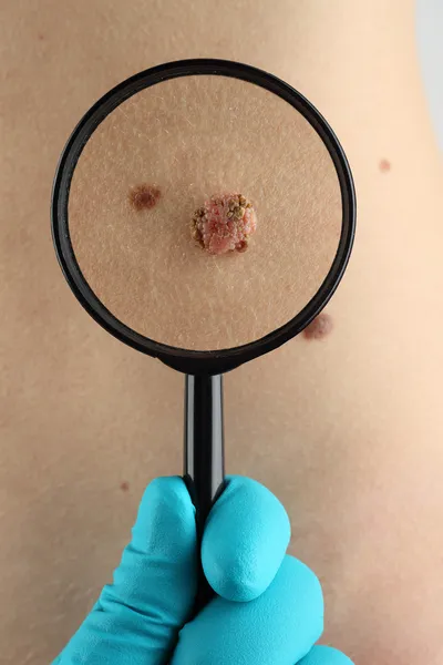 Birthmark. Dermatologist examines mole close up — Stock Photo, Image