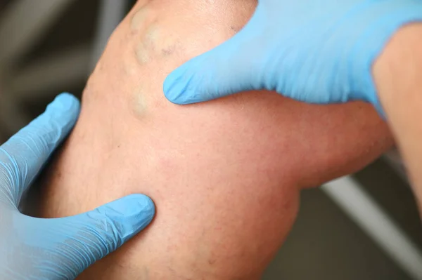 Hlebolog vyšetřuje pacienta s křečovými žilami na noze. — Stock fotografie