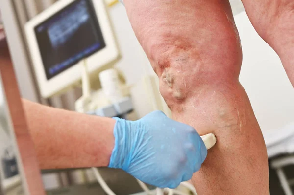 Een fleboloog doet een echo van de aderen van een patiënt met spataderen. — Stockfoto