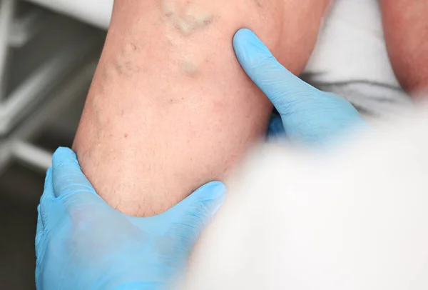 Hlebolog vyšetřuje pacienta s křečovými žilami na noze. — Stock fotografie