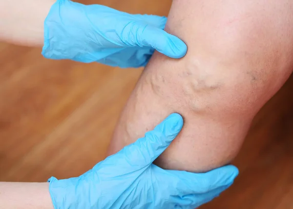 Ärzte mit Gummihandschuhen untersuchen die Krampfadern an den Beinen des Patienten in Großaufnahme. — Stockfoto