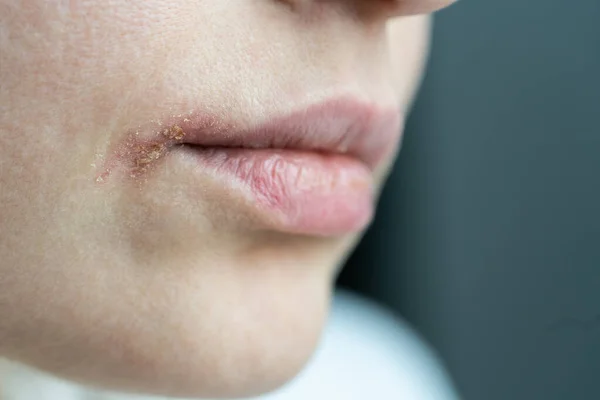 Closeup of sore woman dry lips affected by herpes, suffering from food allergy, infection or virus — Stock Photo, Image