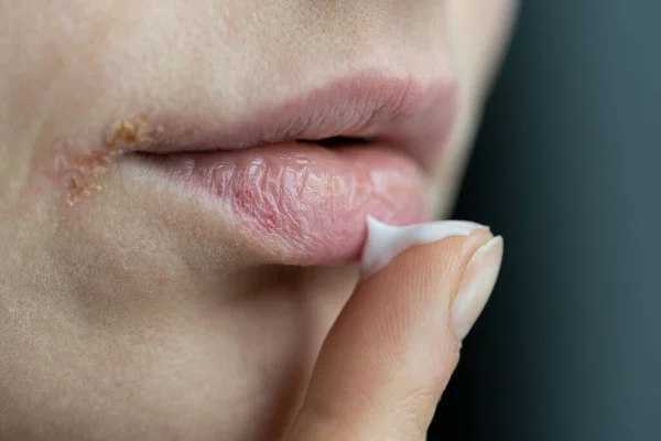 Nahaufnahme einer Frau, die Lippenbalsam mit dem Finger aufträgt, um Trockenheit und Rissbildung in der kalten Jahreszeit zu verhindern — Stockfoto