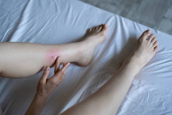 Woman Touches Her Leg Being Bitten Mosquito Bedbug Hotel Suffering — Stock Photo, Image