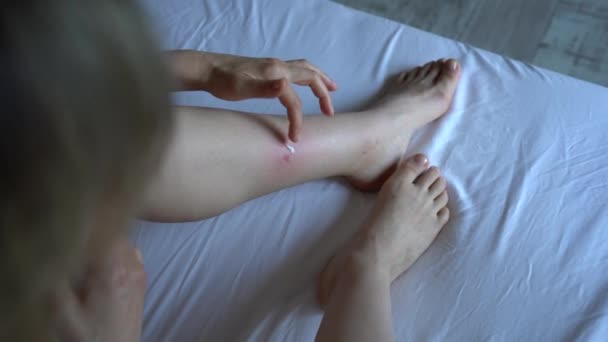 女性は自宅でベッドに座って 蚊や中指から腫れ肌の足にクリームやバームを適用し アレルギー反応や腫れ かゆみの痛みに苦しんでいます 虫刺されに対する個々の不寛容 — ストック動画