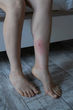 Woman leg after being bitten by mosquito or horsefly in apartment, suffering from allergic reaction and swelling, experiencing pain. Skin reaction to blood-sucking insects. Allergy.  clipart