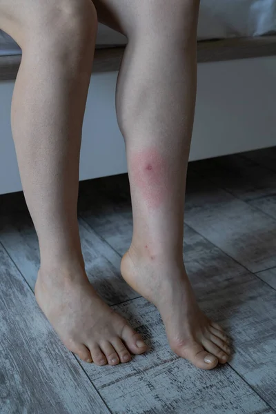 Woman leg after being bitten by mosquito or horsefly in apartment, suffering from allergic reaction and swelling, experiencing pain. Skin reaction to blood-sucking insects. Allergy.